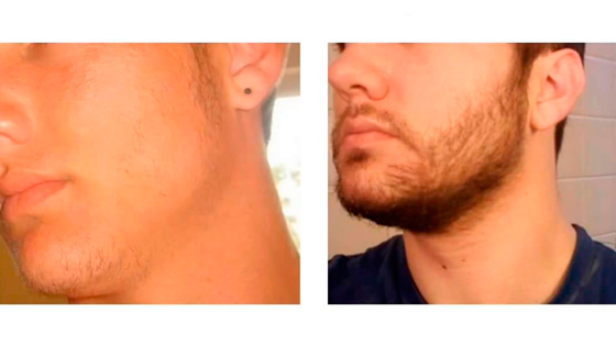 Minoxidil Antes e Depois - Barba